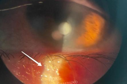 Нижегородец чуть не ослеп из-за контактных линз